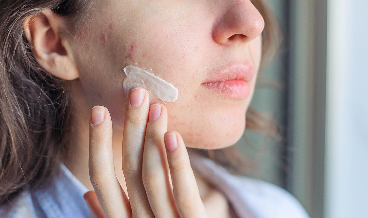 Tretinoin Mart Review: The Pros and Cons You Need to Know